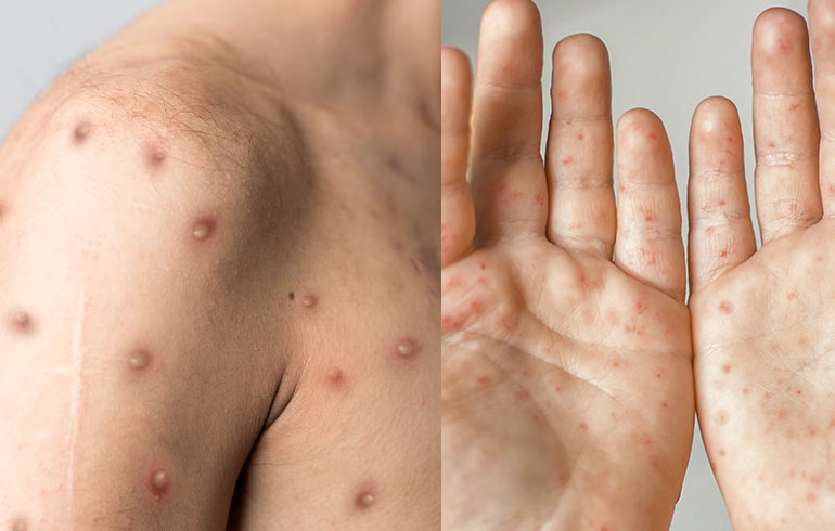 DIAGNÓSTICO DIFERENCIAL ENTRE SÍNDROME DE PIE-MANO-BOCA Y MONKEYPOX
