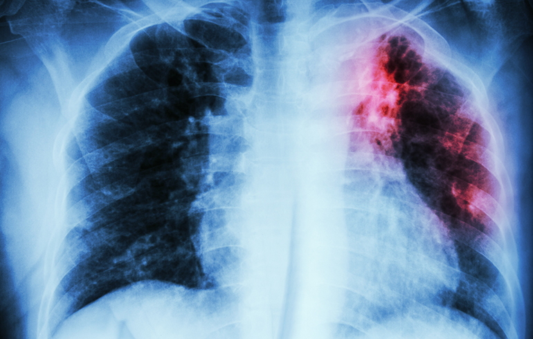 Resumen actualización norma nacional de tuberculosis