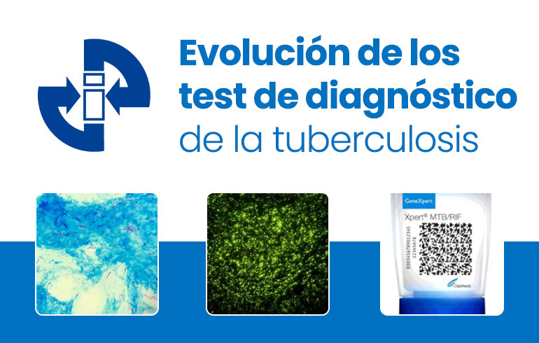 Evolución de los test de diagnóstico de la tuberculosis