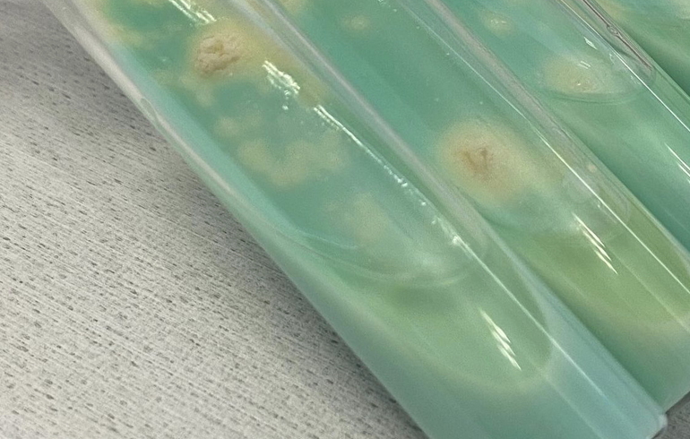 Los efectos severos de la pandemia COVID-19 sobre la pesquisa de tuberculosis