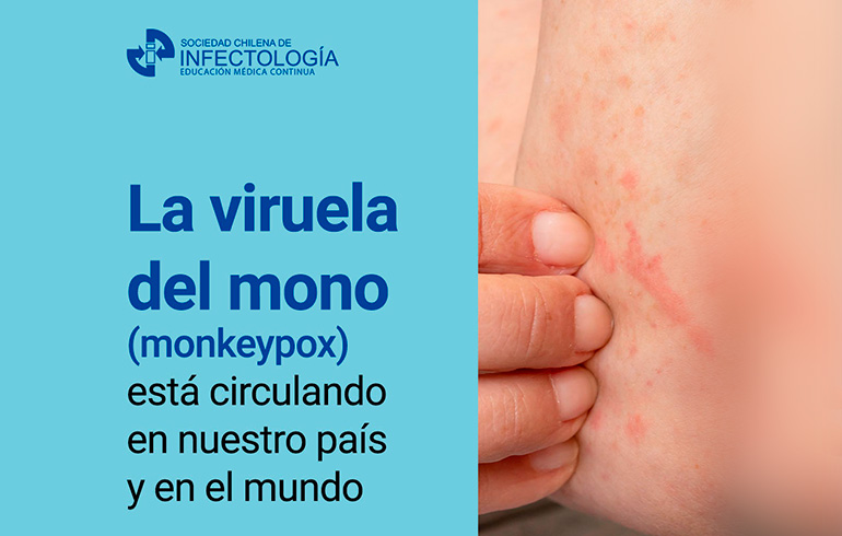 La viruela del mono (monkeypox) está circulado en nuestro país y en el mundo