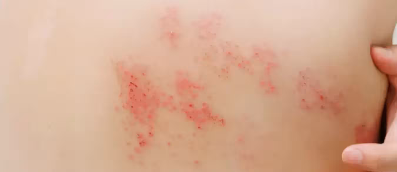 INFORMACIÓN SOBRE LA NUEVA VACUNA RECOMBINANTE CONTRA EL HERPES ZOSTER