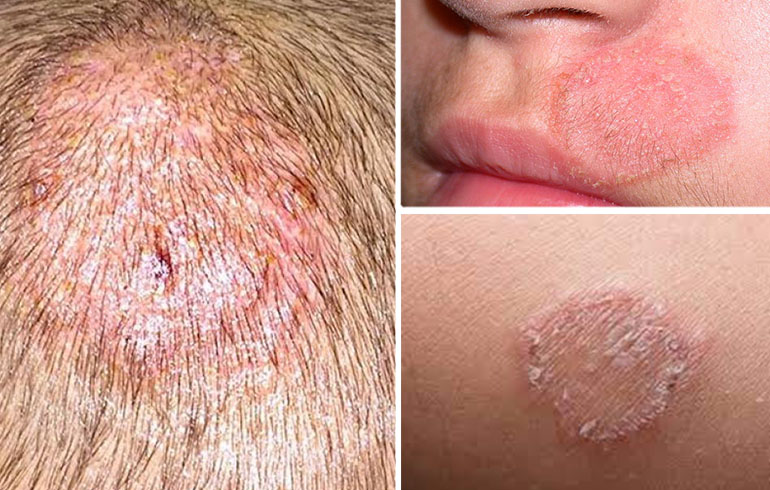 Dermatofitosis