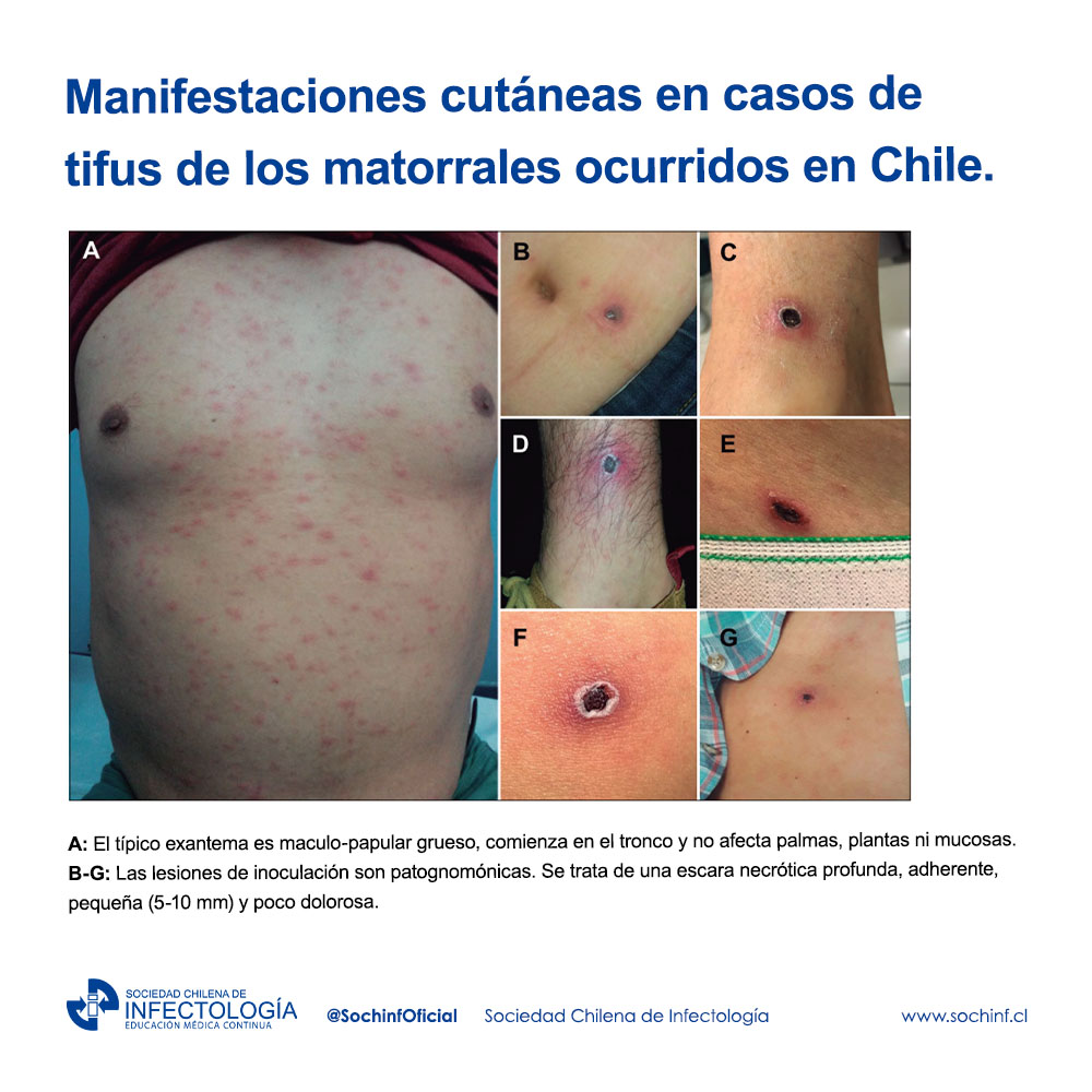 Tifus de los matorrales, una enfermedad emergente en Chile