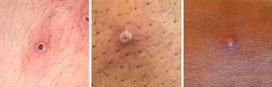 MONKEYPOX – Educar es prevenir