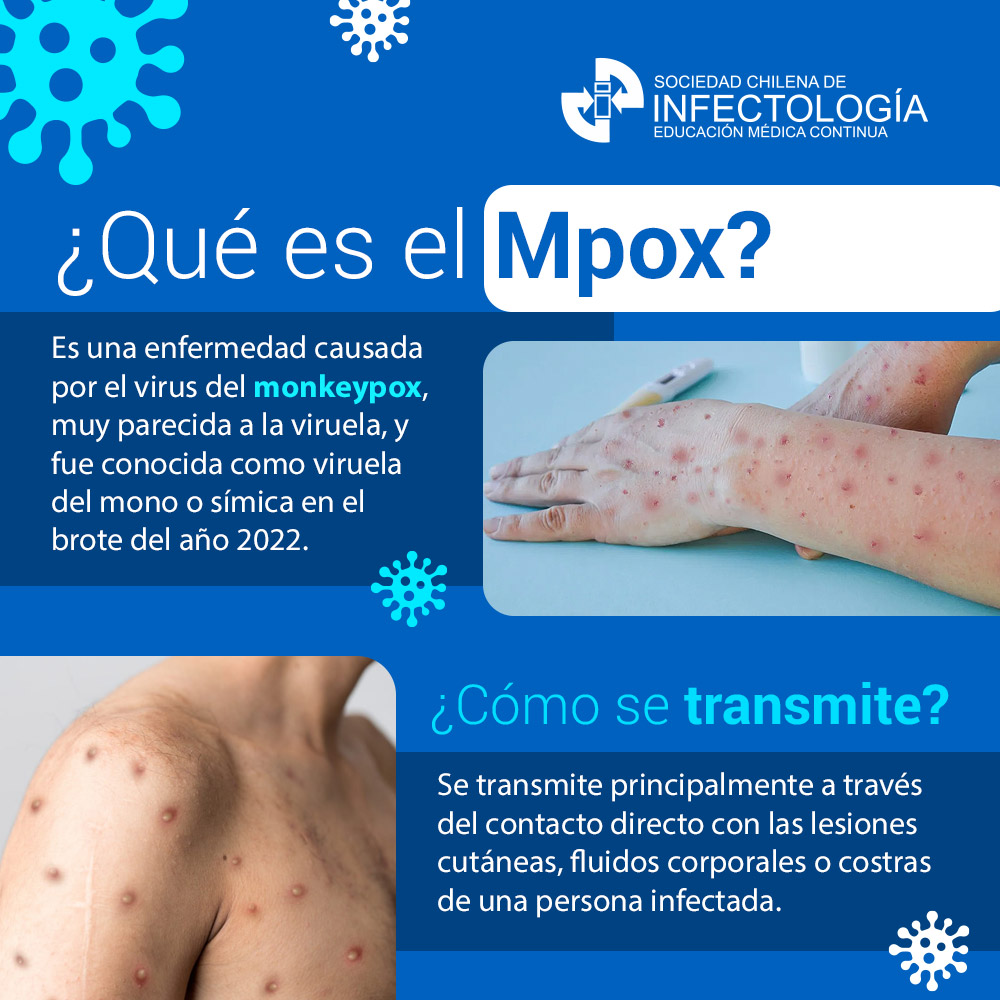¿Qué es el mpox?
