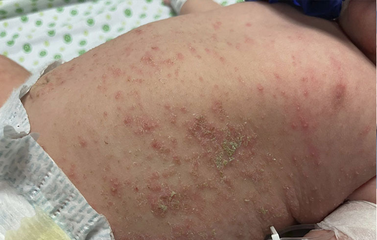 Escabiosis