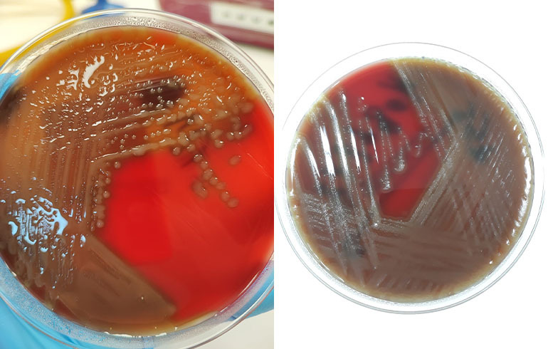 Enfermedad Invasora por S. pneumoniae