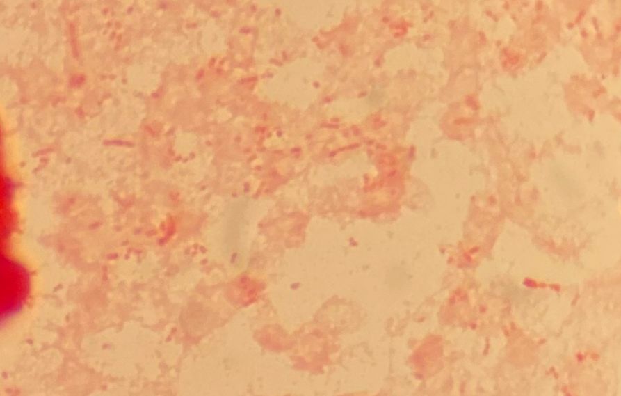 Retrato microbiológico – Haemophilus influenzae
