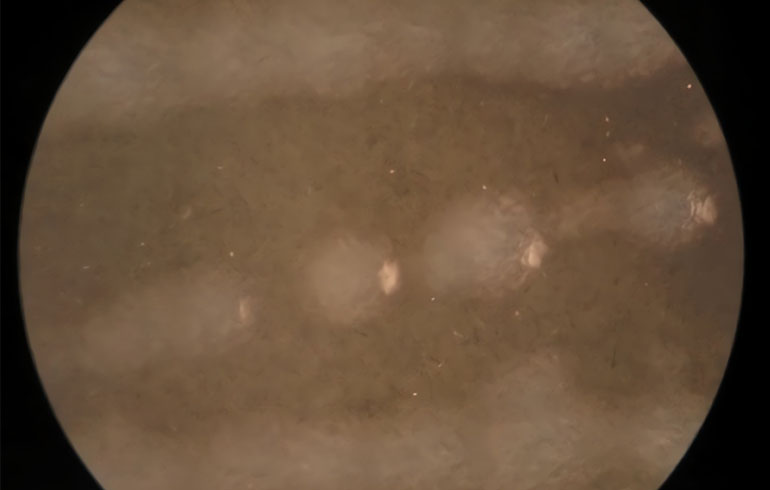 Neumonía causada por Legionella pneumophila | Transmisión y factores de riesgo