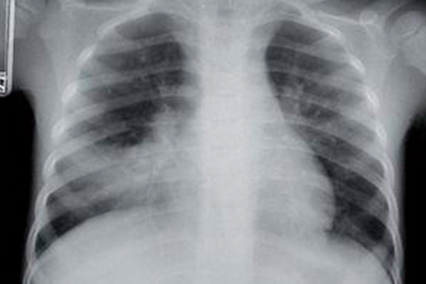 Mycoplasma pneumoniae